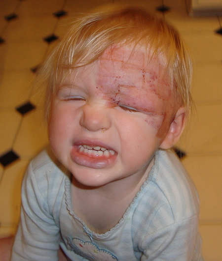 hemangioma on face. coming down her face,