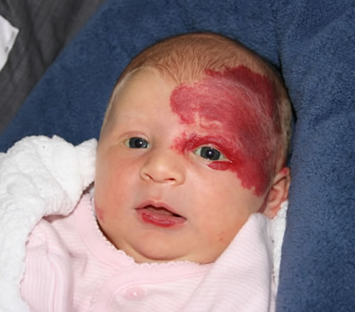 hemangioma on face. Hemangioma, Birth Mark